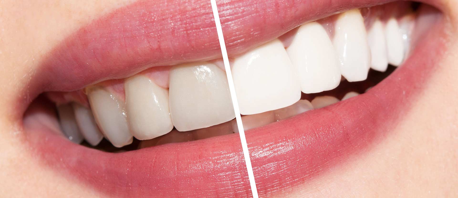 Clareamento Dental, proporciona uma melhora na aparência e auto-estima.
