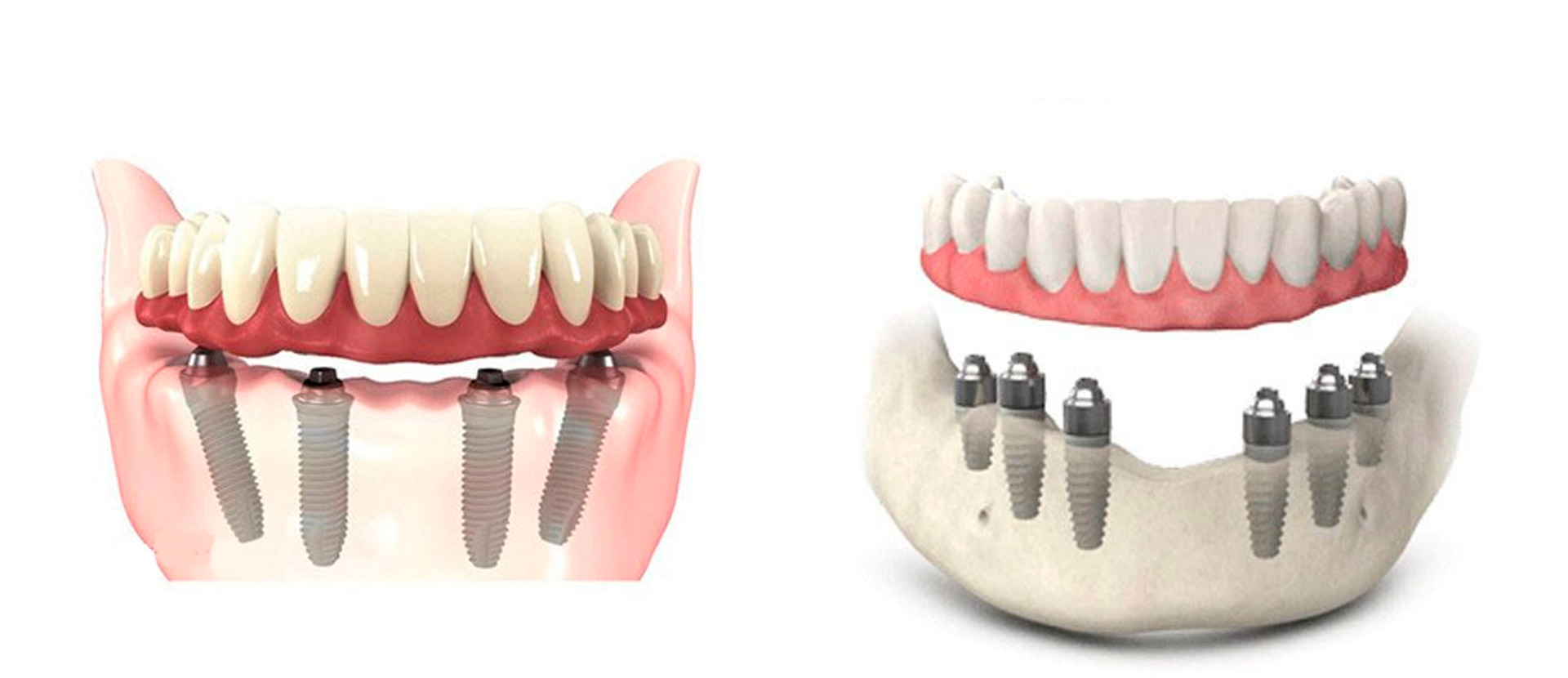 Имплантация зубов all on 6. Имплантация all on 4 челюсть. Имплантация на 4 имплантах нижней челюсти. Протез нижней челюсти на 4 имплантах.