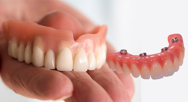 Diferença da prótese protocolo x dentadura – AGN Odontologia