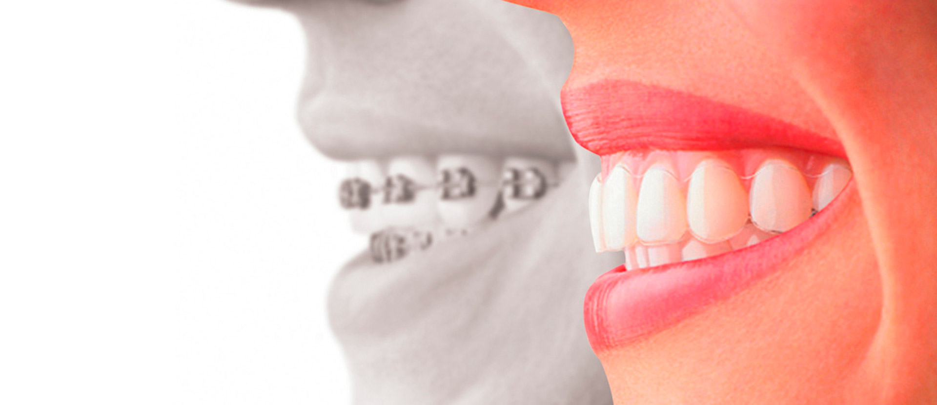 Invisalign – AGN Odontologia