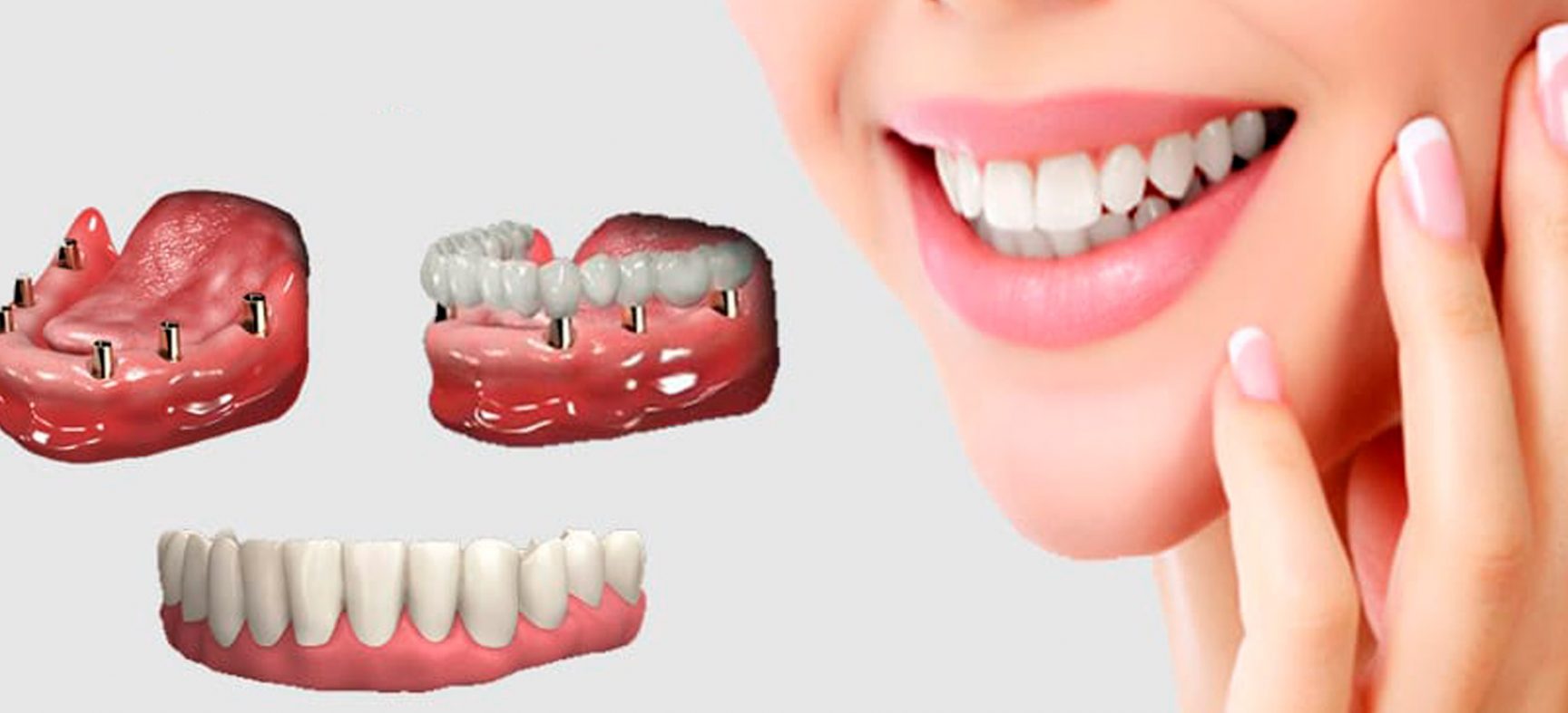 Implantes Dentários