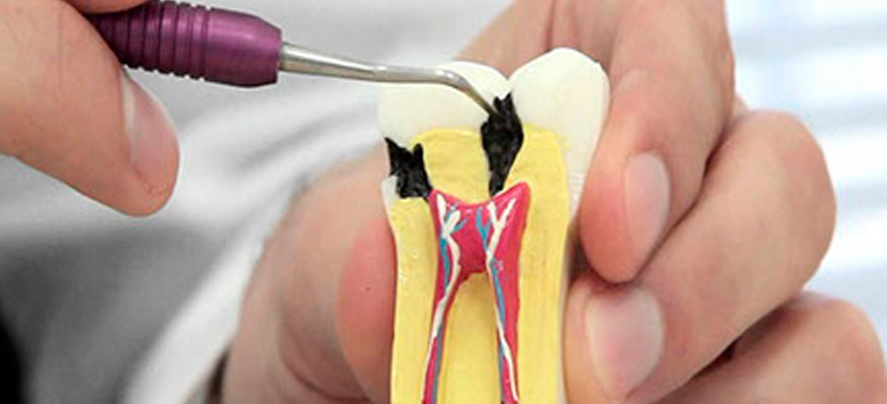 Endodontia Tratamento De Canal Agn Odontologia