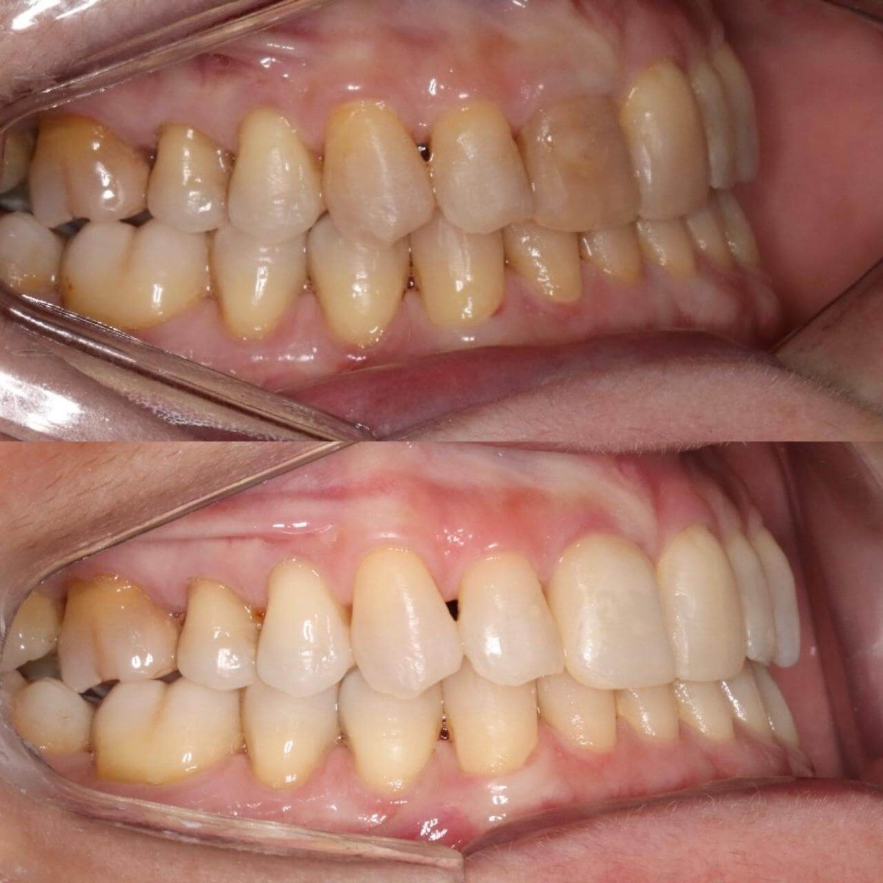 Clareamento dental