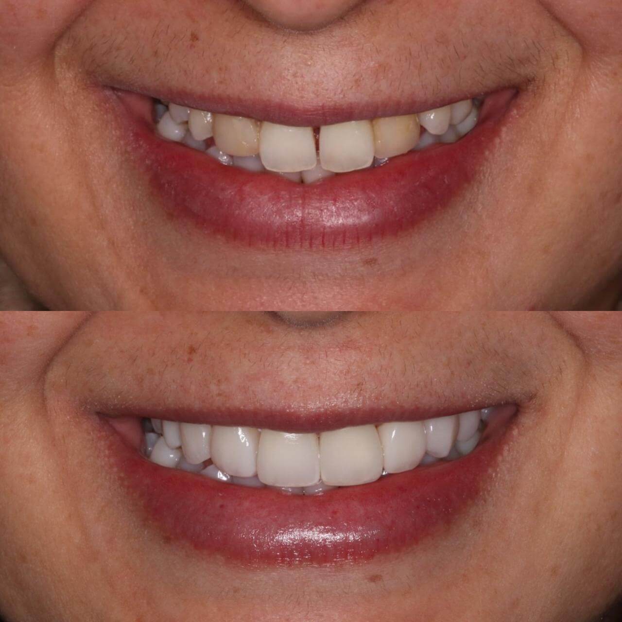 Facetas de resina Mooca