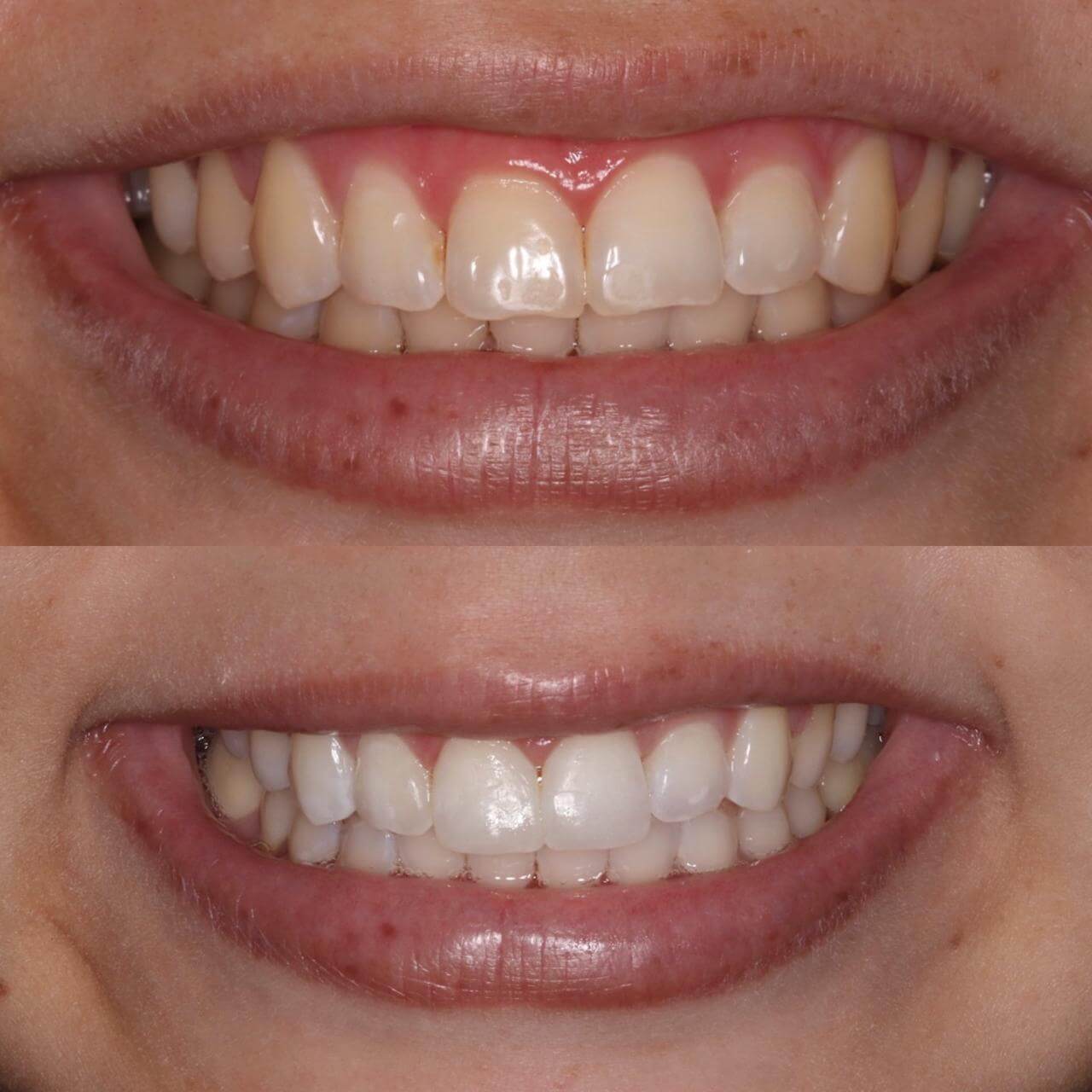 Gengivoplastia