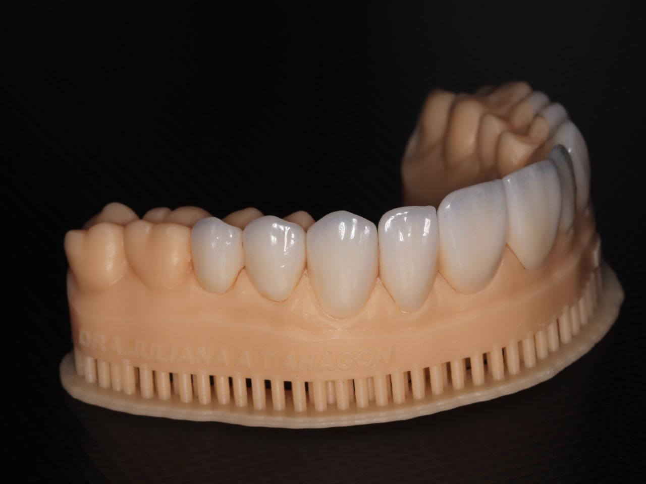 Lentes de porcelana lente de contato dental