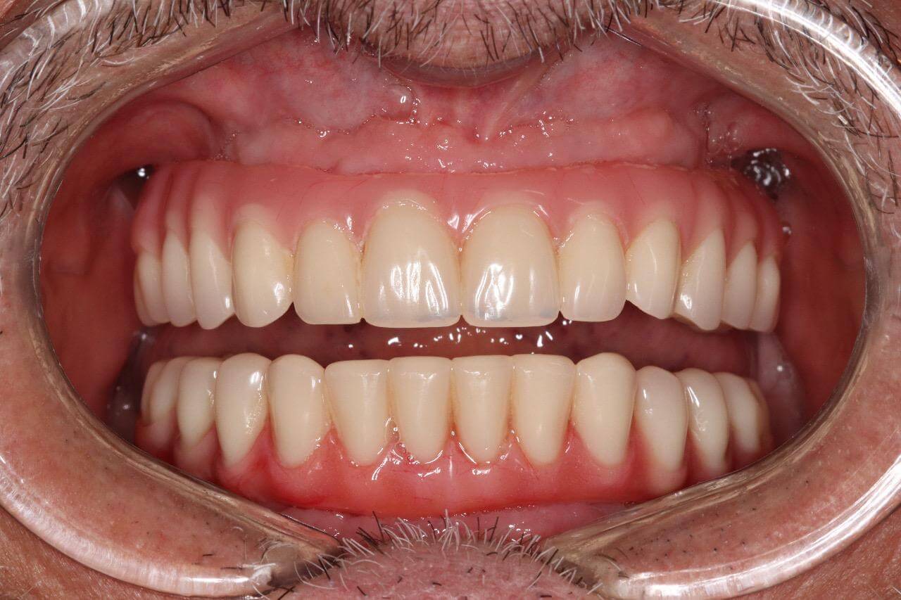 Protocolo Dental duplo