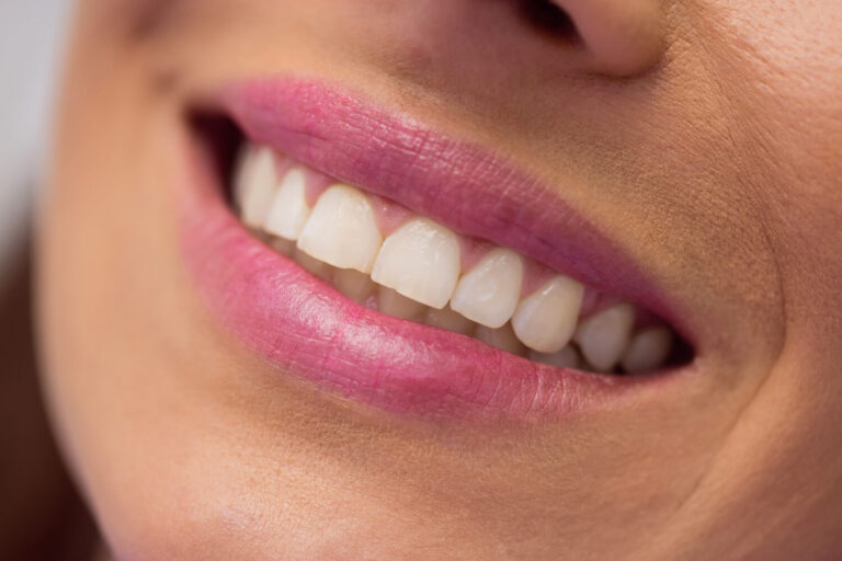 Close do sorriso feminino com dentes brancos e saudáveis após clareamento dental realizado na Clínica AGN Odontologia.
