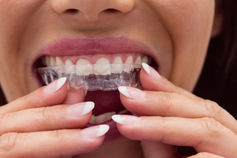 Mulher colocando alinhador invisível nos dentes superiores na Clínica AGN Odontologia, tratando bruxismo e alinhamento na Mooca, SP