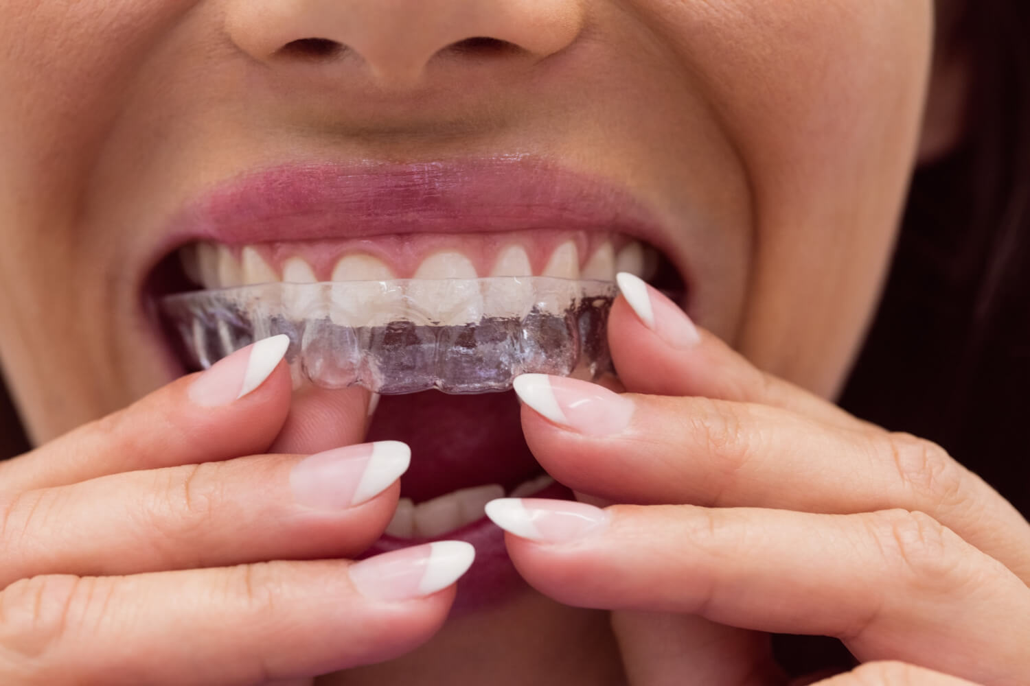 Mulher colocando alinhador invisível nos dentes superiores na Clínica AGN Odontologia, tratando bruxismo e alinhamento na Mooca, SP